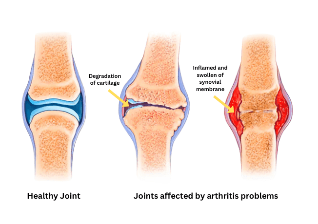 Joints Affected By Arthritis Problems