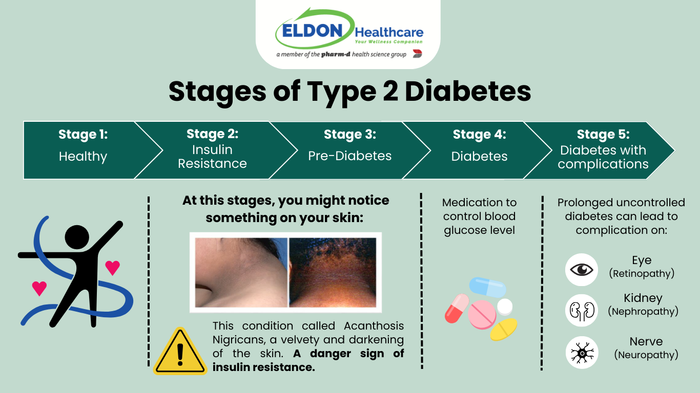 The 5 stages of Diabetes of high blood glucose. Healthy, insulin resistance, pre diabetes, diabetes, and diabetes with complications